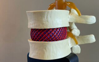 hernia model with scrossed fibers of the intervertebral disk